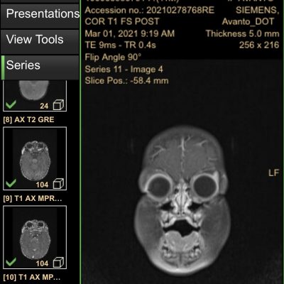 A slightly terrifying screen-grab of a child’s skull and brain from an MRI result video.